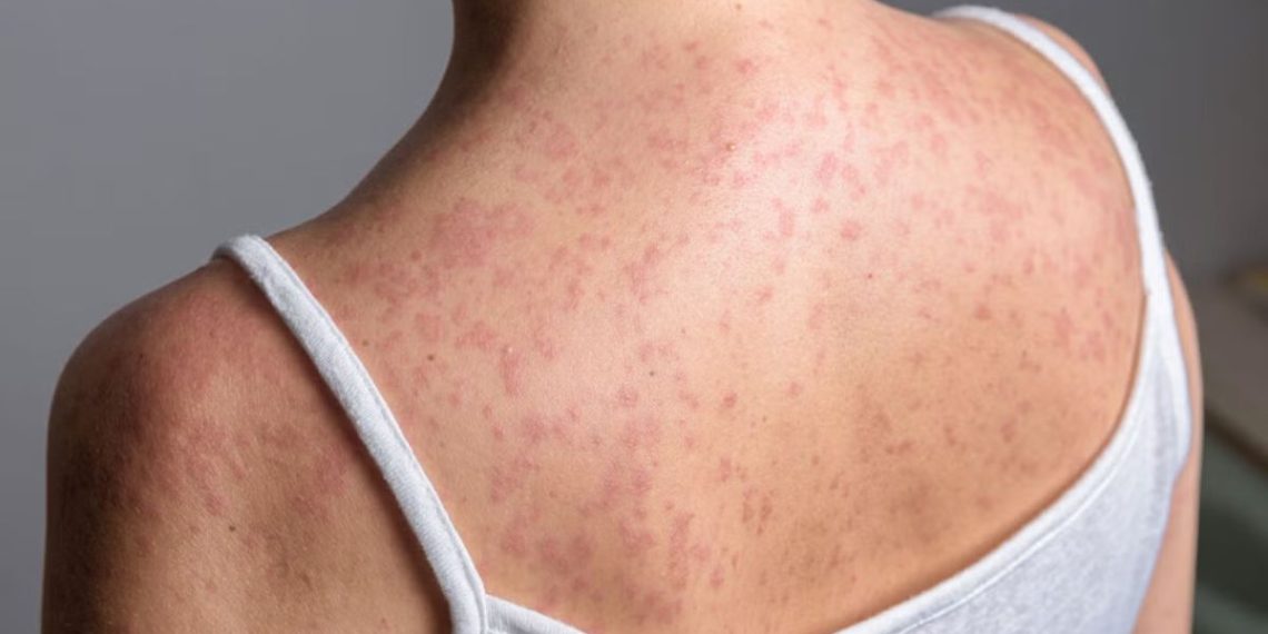 SARAMPIÓN-MÉXICO-ALERTA-SANITARIA