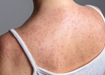 SARAMPIÓN-MÉXICO-ALERTA-SANITARIA