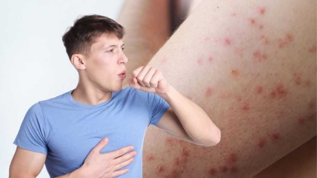 Casos de Sarampión