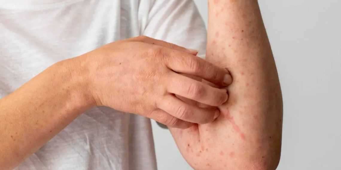 Person in a white shirt rubs or scratches their forearm, which has red, bumpy rash patches on the skin.