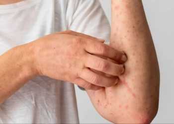 Person in a white shirt rubs or scratches their forearm, which has red, bumpy rash patches on the skin.